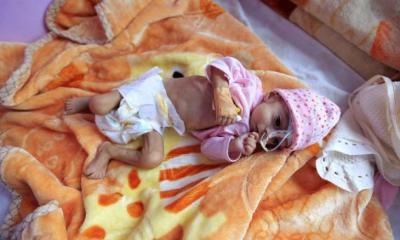  - الصحة العالمية: 46% من أطفال اليمن يعانون التقزم